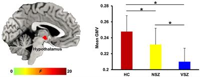 The Deficits of Individual Morphological Covariance Network Architecture in Schizophrenia Patients With and Without Violence